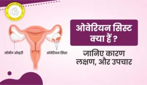 Ovarian Cyst in Hindi ओवेरियन सिस्ट क्या है लक्षण एवं उपचार